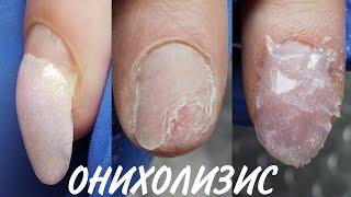 Онихолизис на ногтях, лечение, протезирование, уход в домашних условиях за проблемными ногтями